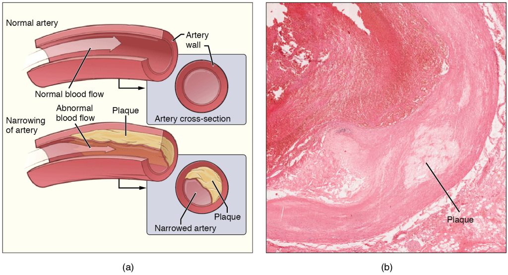 Cross-sectional drawings of a normal blood vessel artery and arteriosclerotic blood vessel, showing the diminished flow due to plaque