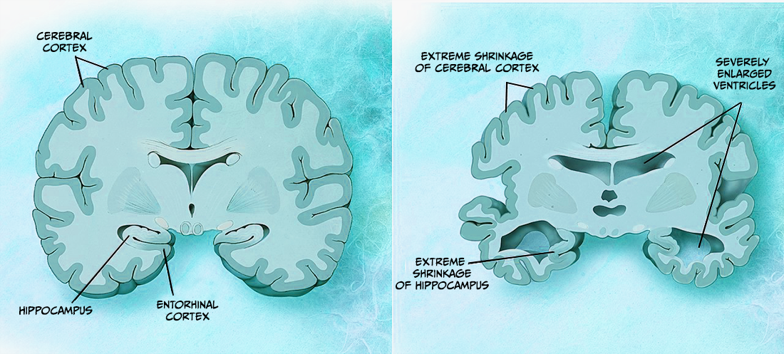 Cross-sectional brain representation of macroscopic changes that occur with Alzheimer’s disease, compared to a healthy brain