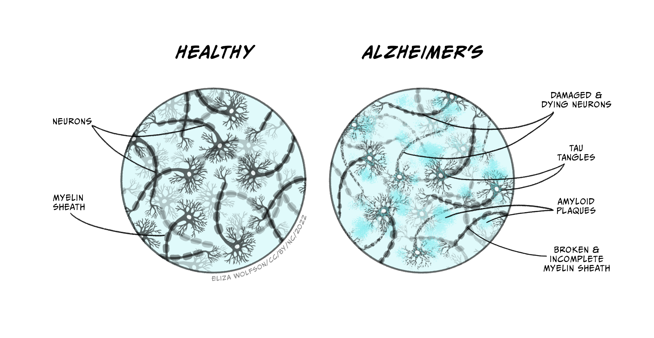 Drawing showing microscopic changed with Altzheimer's, including Tau tangles, damaged and dying neurons, and amyloid plaques, compared to a drawing of a healthy brain