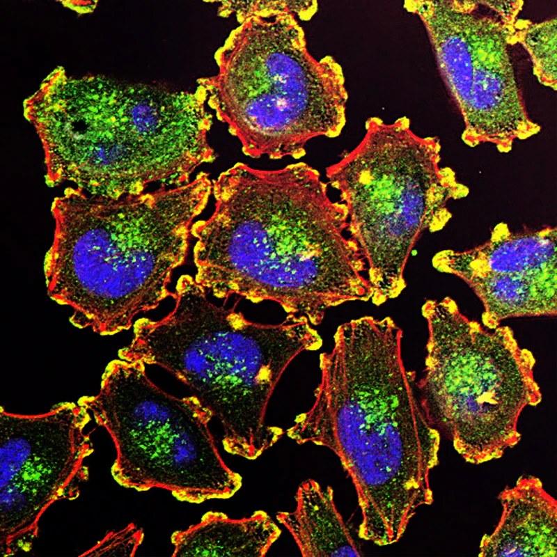Human Metastatic Melanoma Cells. Image shows two important features of mammalian cells, the nuclei in blue and actin polymers in red
